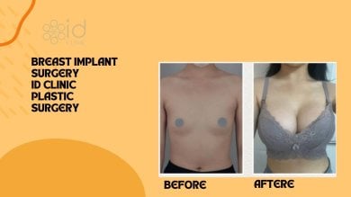 before-after photo breast-implants-with-breast-lift