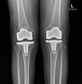 before-after photo total-knee-replacement-tkr-with-omni