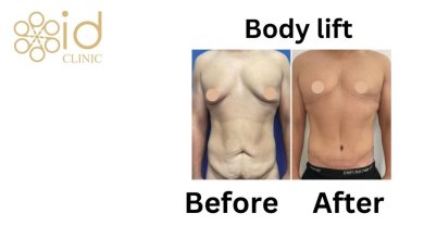 before-after photo penis-enlargement
