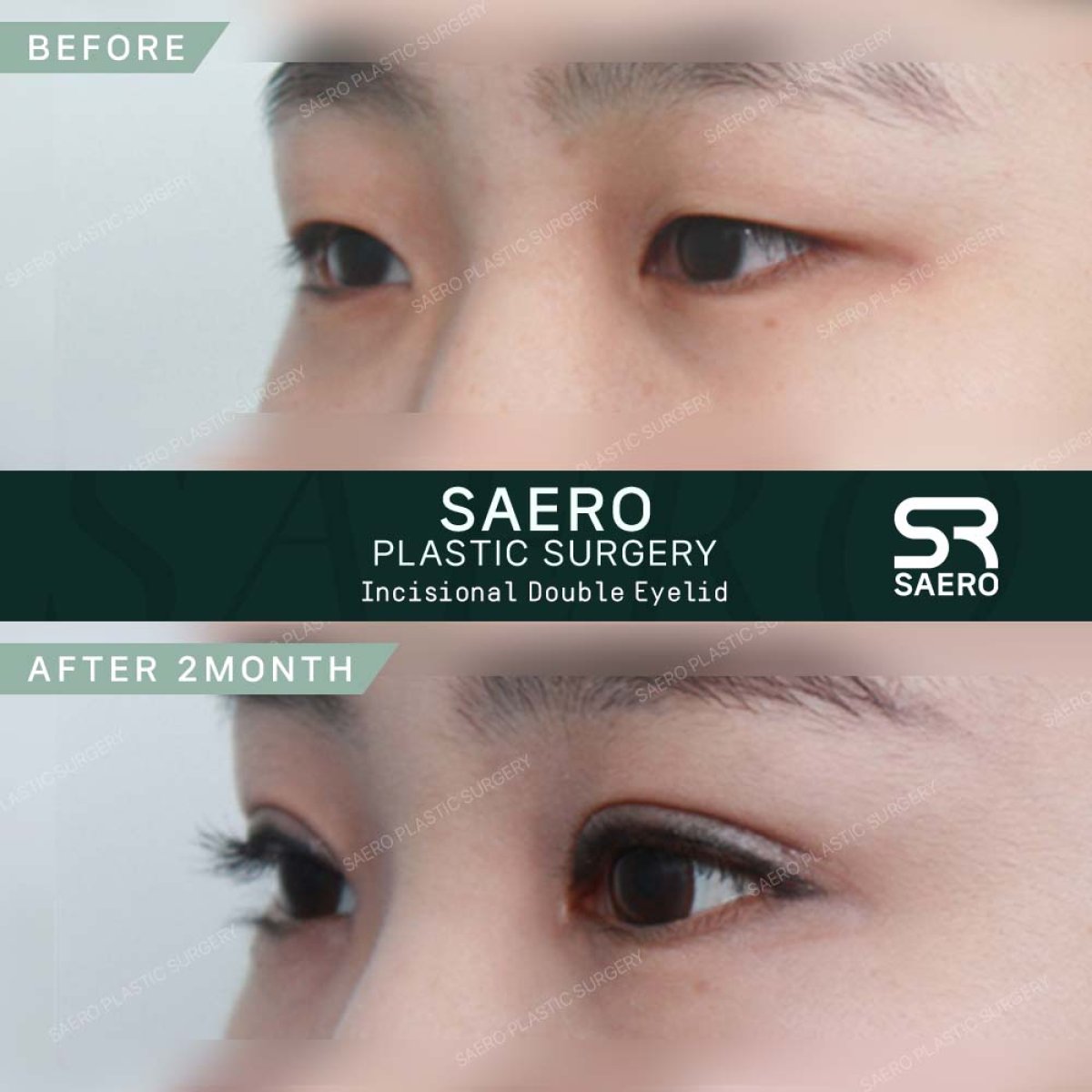 نتائج قبل وبعد جراحة الجفن المزدوج في SAERO Plastic Surgery بعد شهرين من العملية