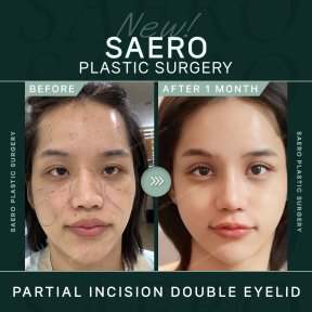 Before and after partial incision double eyelid surgery result at SAERO Plastic Surgery