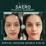 Before and after partial incision double eyelid surgery result at SAERO Plastic Surgery