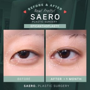 Before and after epicanthoplasty results at SAERO Plastic Surgery, visible eye shape improvement
