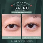 Before and after epicanthoplasty results at SAERO Plastic Surgery, visible eye shape improvement