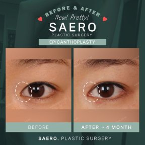 Before and after epicanthoplasty results at SAERO Plastic Surgery, eye shape enhancement