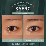 Before and after epicanthoplasty results at SAERO Plastic Surgery, eye shape enhancement
