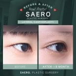 Before and after cat eye surgery (canthoplasty) results at SAERO Plastic Surgery clinic