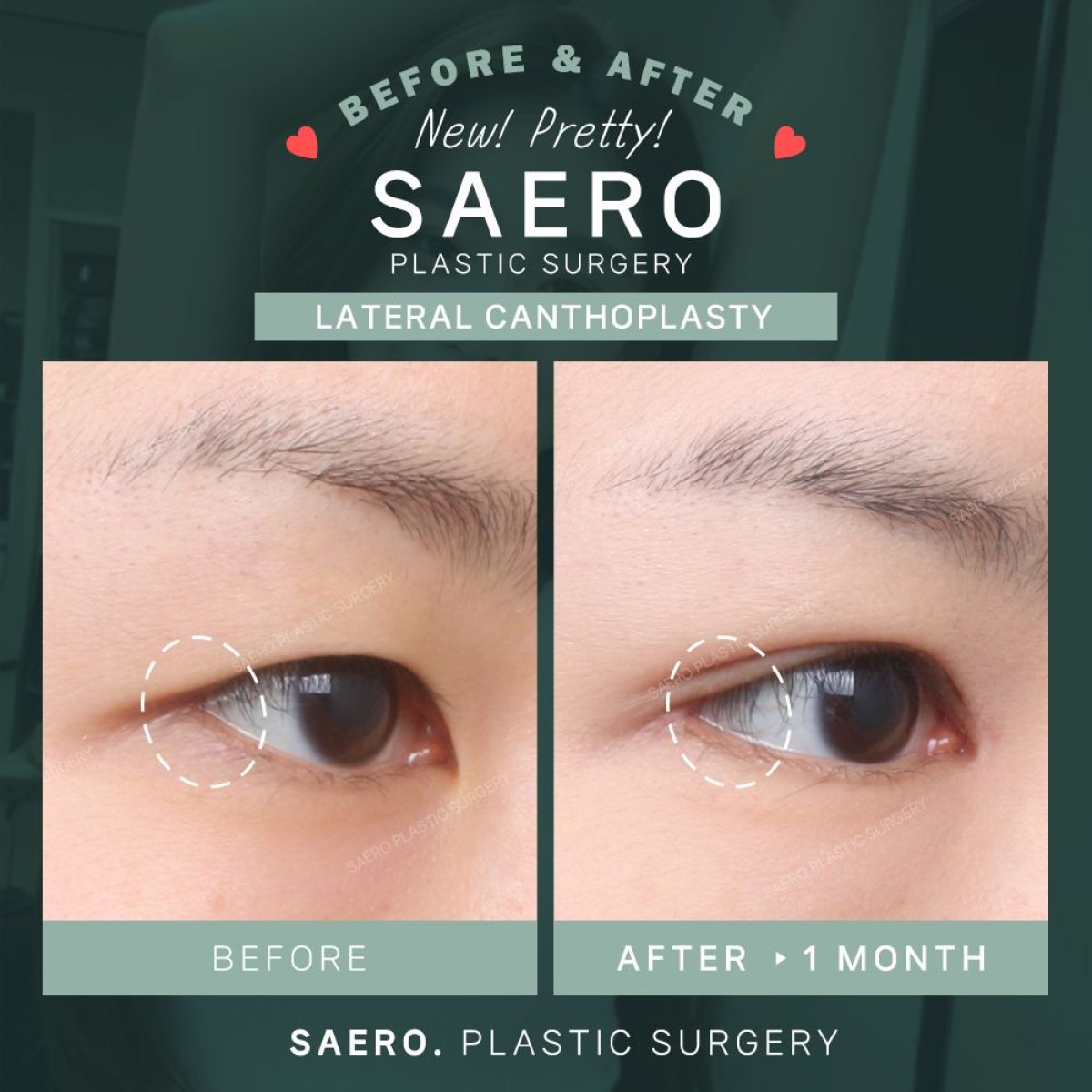 Resultados antes y después de cirugía cat eye (canthoplastia) en SAERO Plastic Surgery