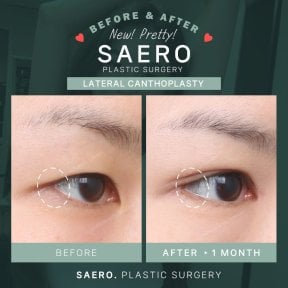 Before and after cat eye surgery (canthoplasty) results at SAERO Plastic Surgery clinic
