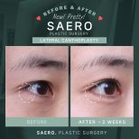 Before and after cat eye surgery (lateral canthoplasty) results at SAERO Plastic Surgery