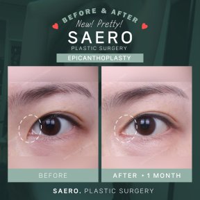 Before and after epicanthoplasty results at SAERO Plastic Surgery, eye shape enhancement