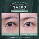 Before and after epicanthoplasty results at SAERO Plastic Surgery, eye shape enhancement