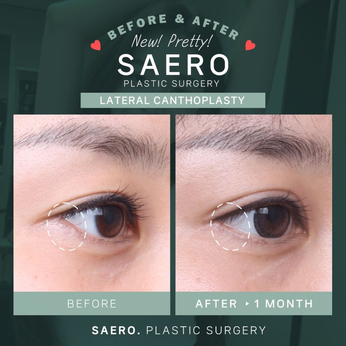 نتائج عملية عيون القطة (كانثوبلاستي) قبل وبعد في عيادة SAERO Plastic Surgery