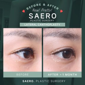 Before and after cat eye surgery (canthoplasty) results at SAERO Plastic Surgery clinic