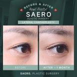 Before and after cat eye surgery (canthoplasty) results at SAERO Plastic Surgery clinic