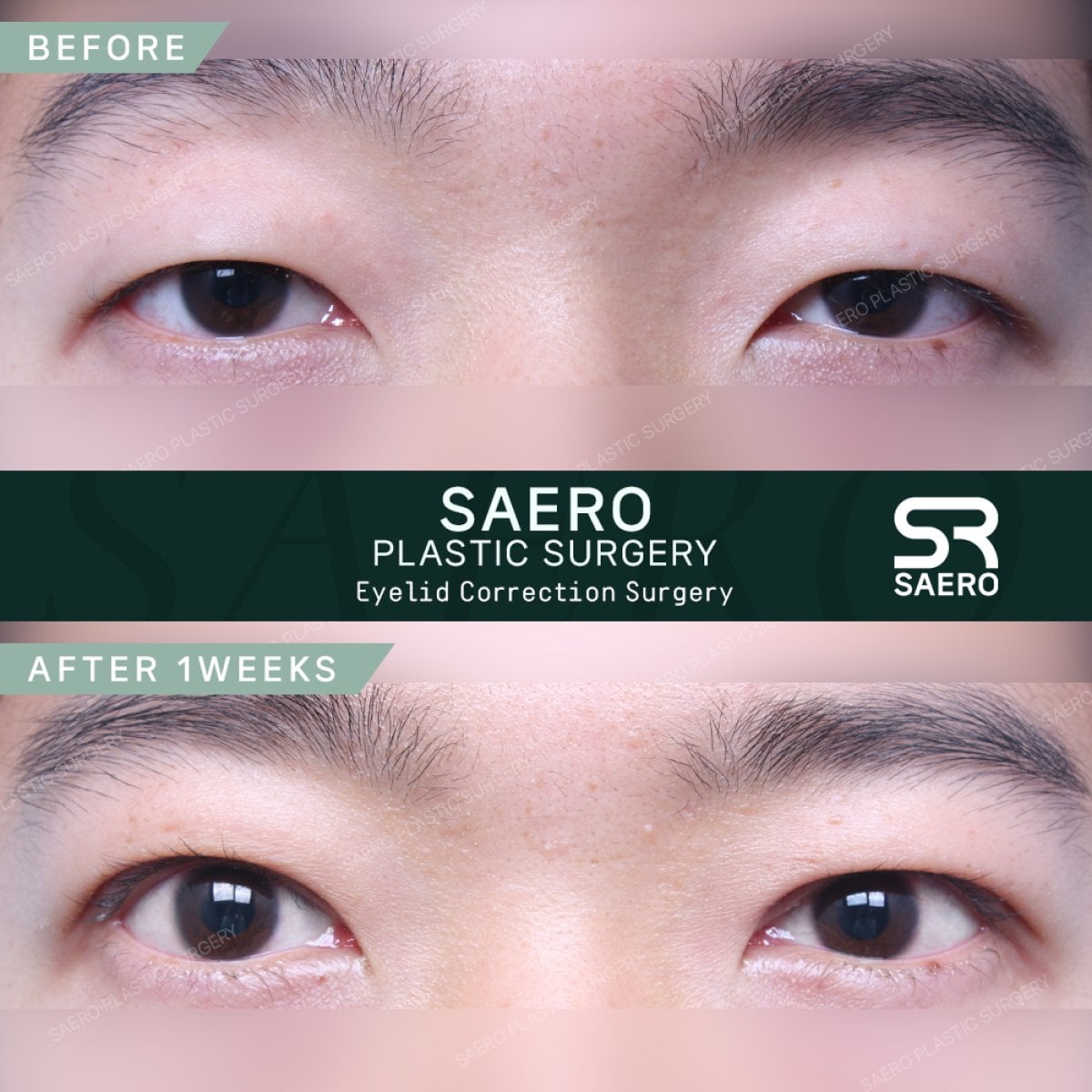 نتائج قبل وبعد جراحة الجفن المتدلي في SAERO Plastic Surgery، مظهر عين محسّن
