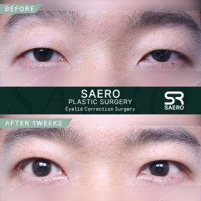 Before and after droopy eyelid surgery results at SAERO Plastic Surgery, improved eye appearance