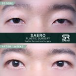 Before and after droopy eyelid surgery results at SAERO Plastic Surgery, improved eye appearance