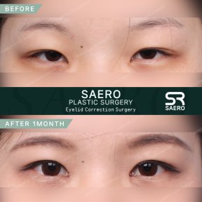 Before and after droopy eyelid surgery results at SAERO Plastic Surgery, improved eye appearance
