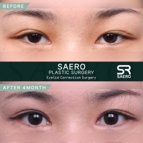 Before and after droopy eyelid surgery results at SAERO Plastic Surgery, improved eye appearance