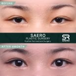 Before and after droopy eyelid surgery results at SAERO Plastic Surgery, improved eye appearance