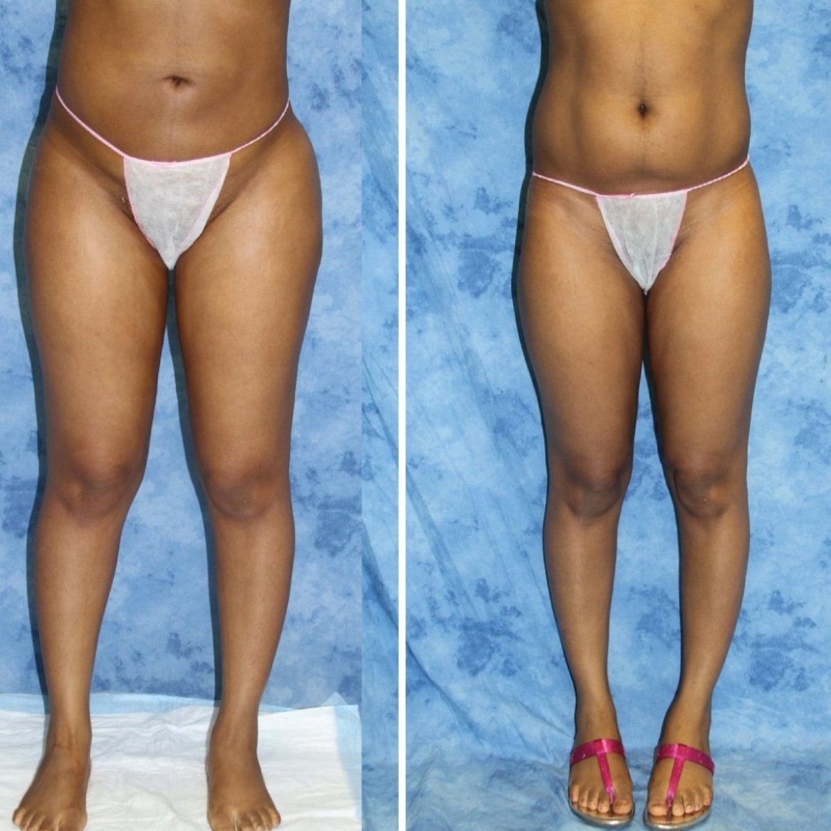 Resultados de liposucción antes y después en Private Yüzyıl Hospital, contorno corporal mejorado
