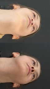 before-after photo rhinoplasty-nose-job