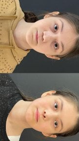 before-after photo rhinoplasty-nose-job