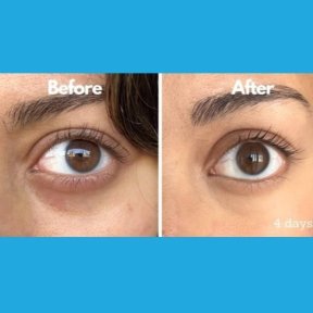 before-after photo skin-rejuvenation