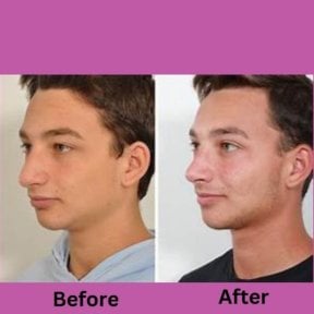 before-after photo ultrasonic-rhinoplasty