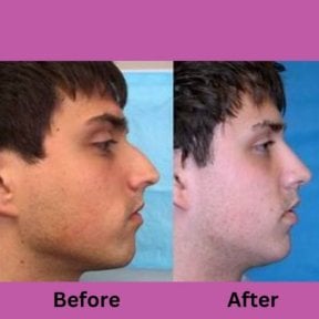 before-after photo ultrasonic-rhinoplasty
