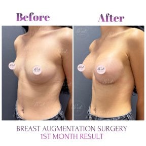 before-after photo breast-augmentation