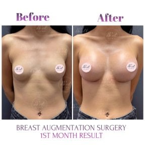 before-after photo breast-augmentation