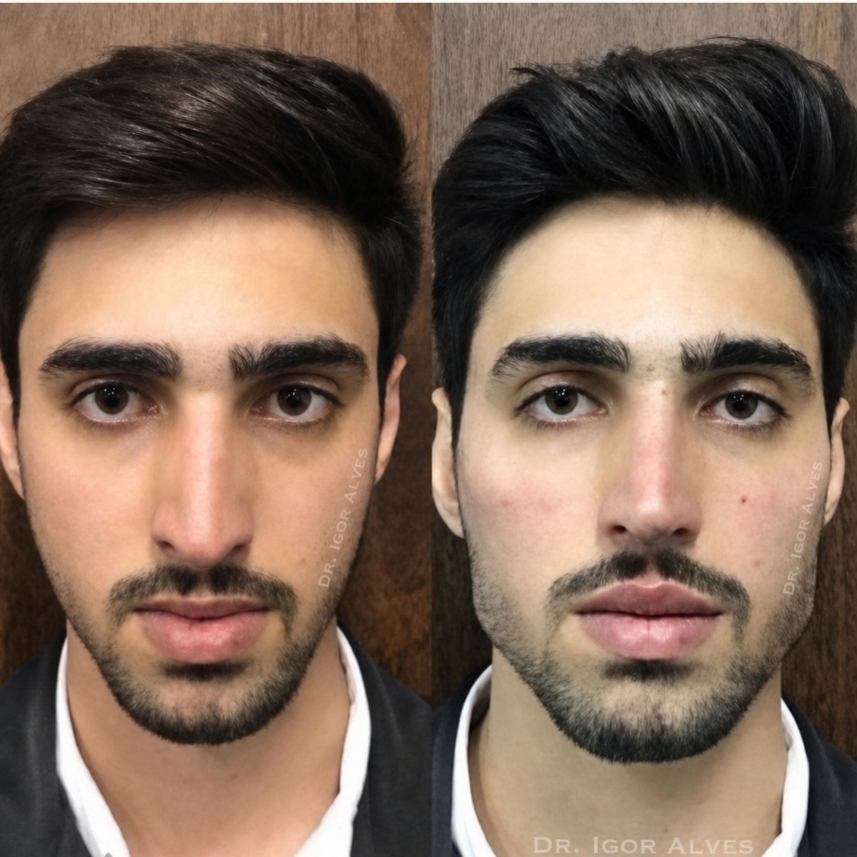 نتائج تجميل الأنف قبل وبعد في ID Clinic Bangkok، تحسين شكل الأنف وتناسقه