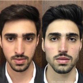 before-after photo rhinoplasty-nose-job
