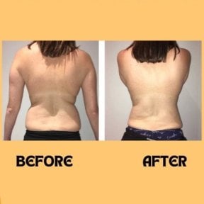 before-after photo vaser-liposuction