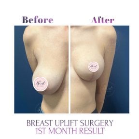 before-after photo mastopeksia-podtazka-grudi-konturnaa-plastika