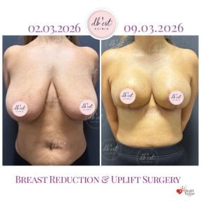 before-after photo mastopeksia-podtazka-grudi-konturnaa-plastika