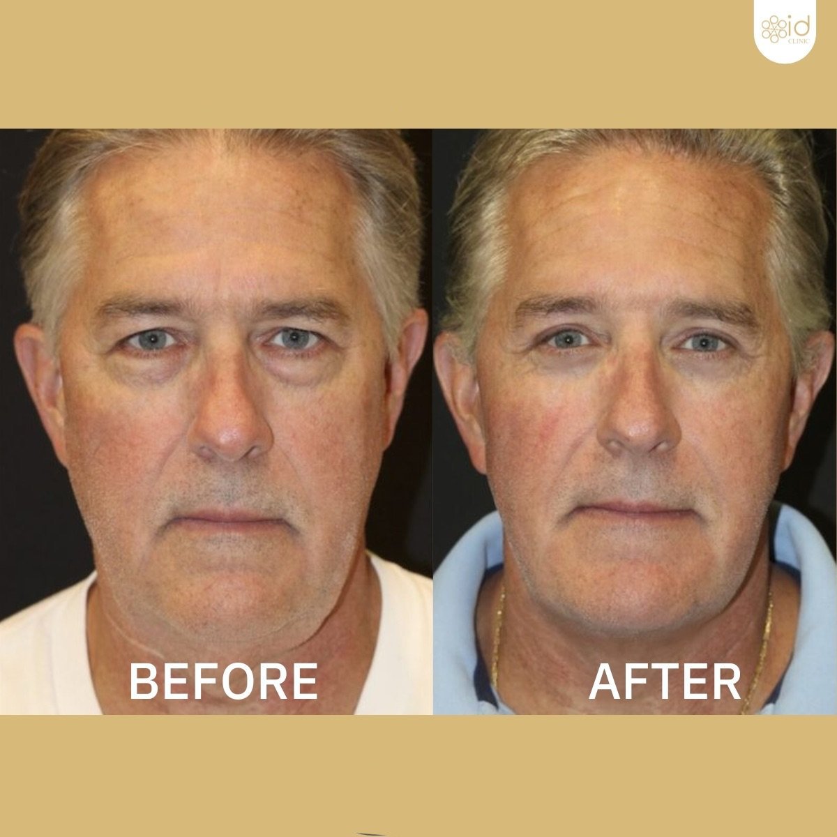 Resultados de lifting de cejas antes y después en ID Clinic Bangkok, rejuvenecimiento visible