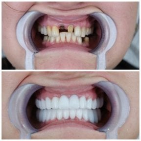 before-after photo dental-implant