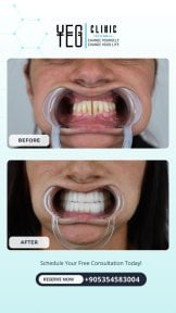 before-after photo all-on-4-dental-implants
