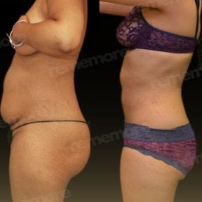 before-after photo vaser-liposuction