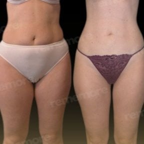 before-after photo vaser-liposuction