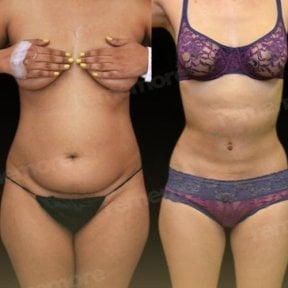 before-after photo vaser-liposuction