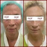 Resultados de lifting facial antes y después en DGB Clinic – rejuvenecimiento visible