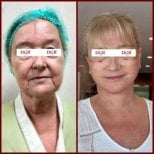 Resultados de lifting facial antes y después en DGB Clinic – rejuvenecimiento visible
