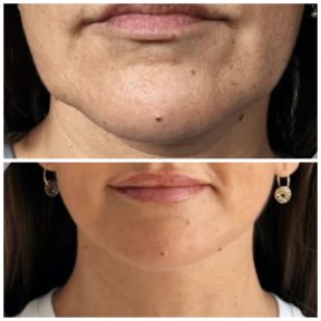 Vorher-nachher-Ergebnis Facelift bei Klinika Promedion, straffere Kinnlinie und Hals