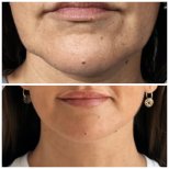 Vorher-nachher-Ergebnis Facelift bei Klinika Promedion, straffere Kinnlinie und Hals