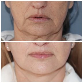 Facelift Vorher-Nachher-Ergebnisse bei Klinika Promedion – sichtbare Hautstraffung