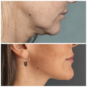 Vorher-nachher Facelift bei Klinika Promedion – verbesserte Kiefer- und Halspartie